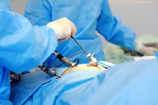Laparoscopic Surgery